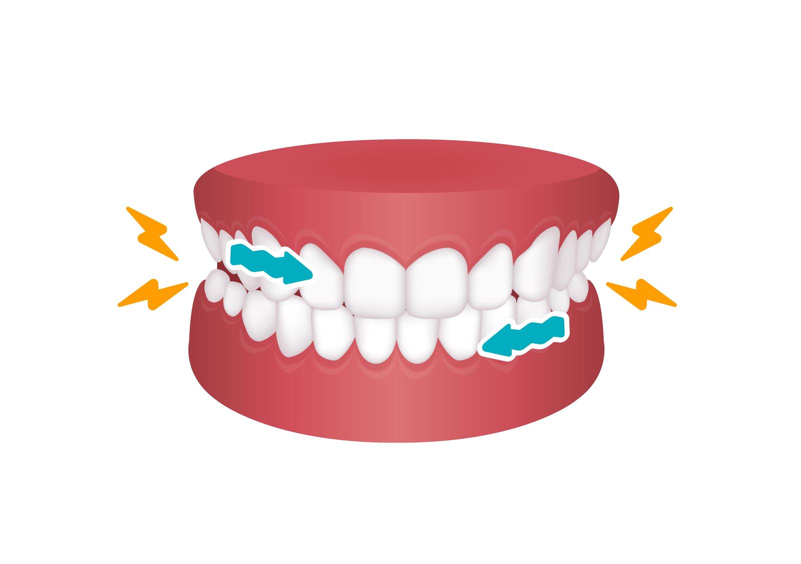 Can Teeth Grinding Be Cured? - Happy Sleep
